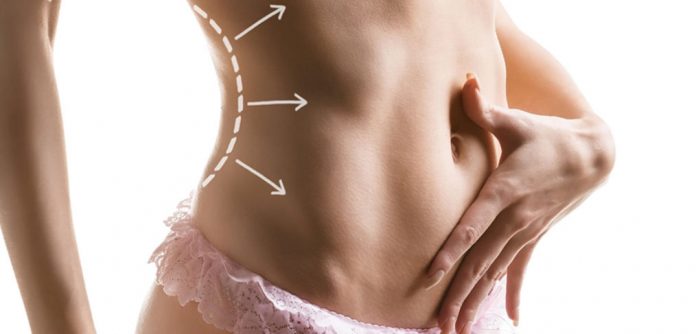 Liposuzione Roma
