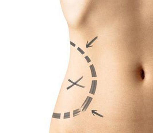 Liposuzione Roma Liposuzione Roma